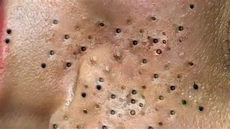 to3PBBN1T RESTMORE (60 Day) httpsamzn. . Newest blackhead removal videos 2023 loan nguyen